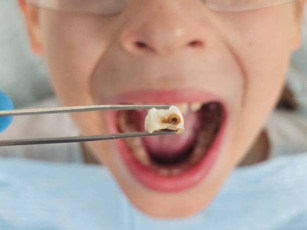 Best Emergency Dental Extractions in Old Forge, PA